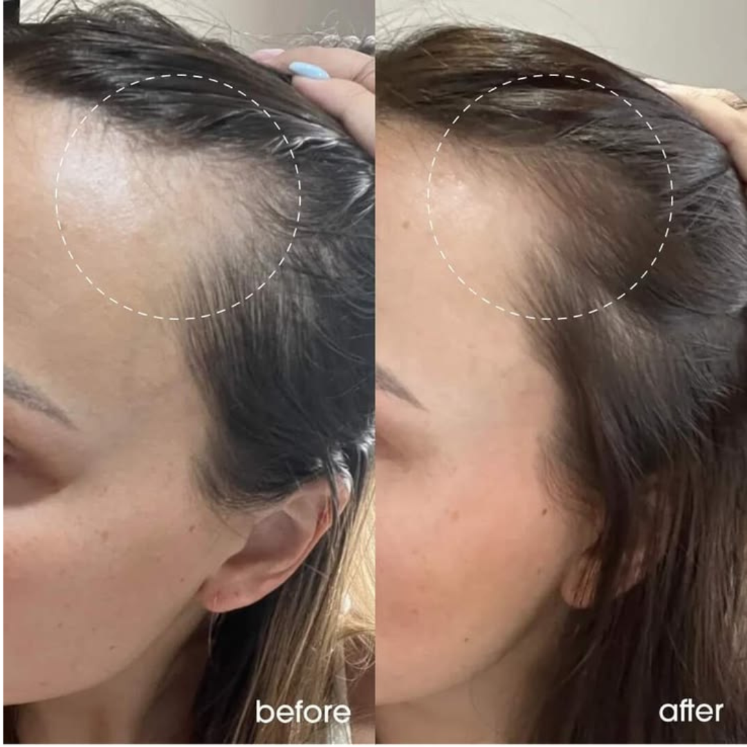 Proskire Hair Growth Serum – Reduces Hair Fall, Boosts Density, Activates Follicles – For Bald Patches, Receding Hairline & Thinning Hair