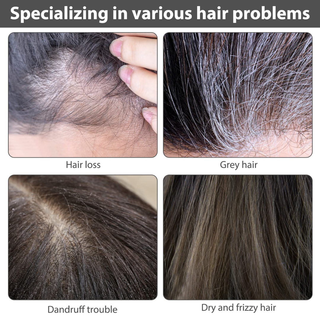 Proskire Hair Growth Serum – Reduces Hair Fall, Boosts Density, Activates Follicles – For Bald Patches, Receding Hairline & Thinning Hair