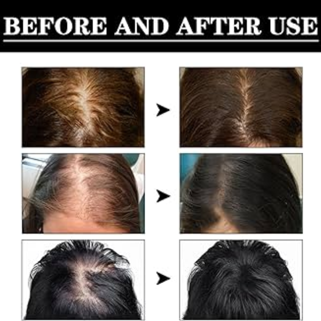 Proskire Hair Growth Serum – Reduces Hair Fall, Boosts Density, Activates Follicles – For Bald Patches, Receding Hairline & Thinning Hair