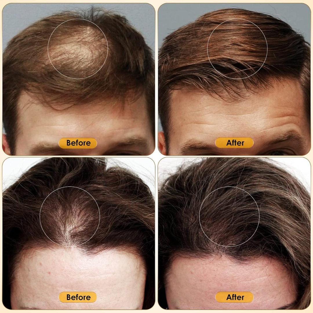 Proskire Hair Growth Serum – Reduces Hair Fall, Boosts Density, Activates Follicles – For Bald Patches, Receding Hairline & Thinning Hair