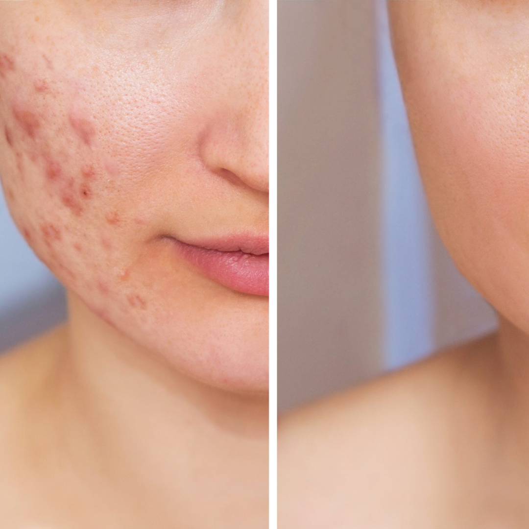 Conscious Chemist Acne Relief Gel | Reduces Pimples Fast | Controls Oil | Calms Redness