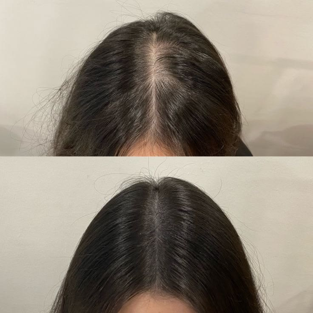 Proskire Hair Growth Serum – Reduces Hair Fall, Boosts Density, Activates Follicles – For Bald Patches, Receding Hairline & Thinning Hair