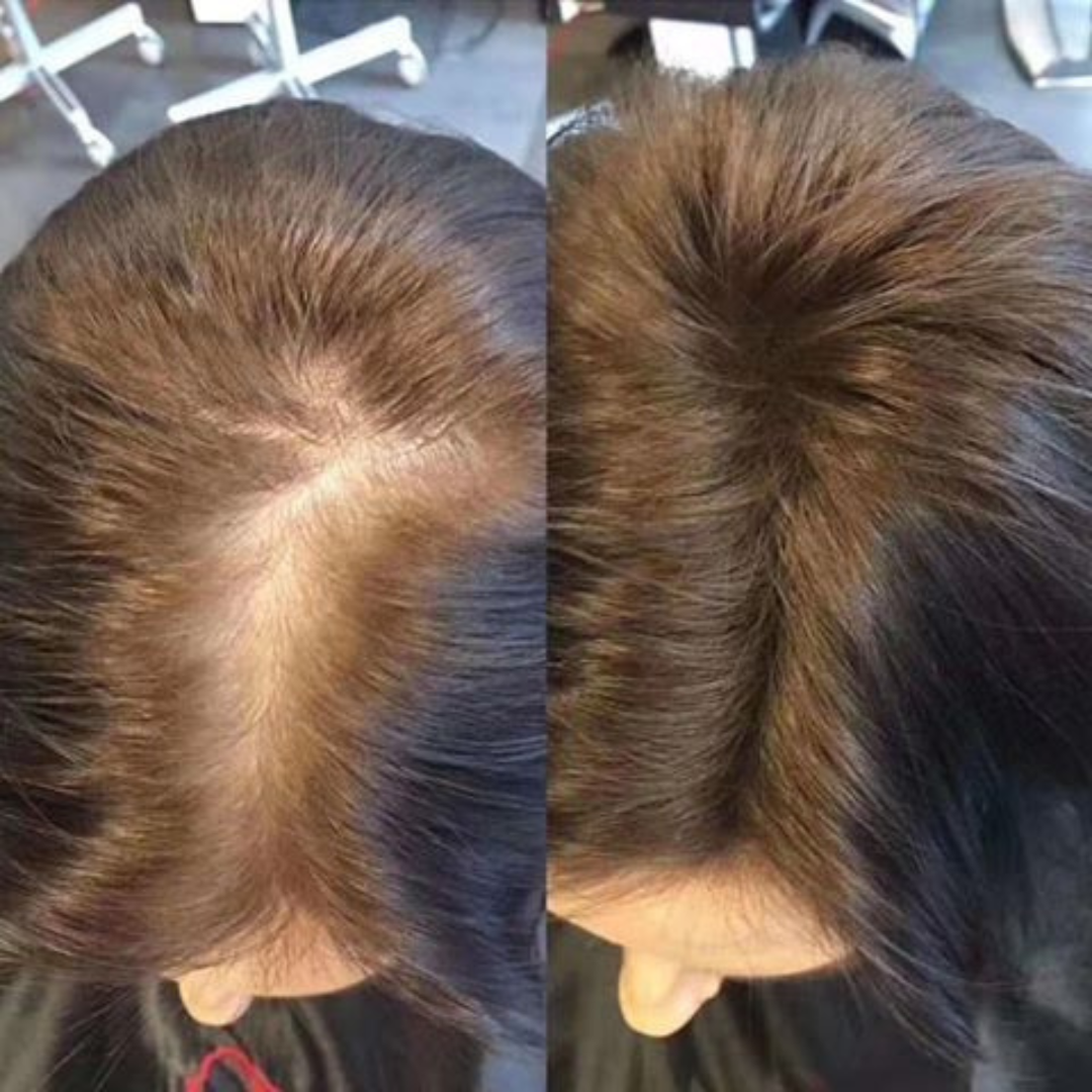 Proskire Hair Growth Serum – Reduces Hair Fall, Boosts Density, Activates Follicles – For Bald Patches, Receding Hairline & Thinning Hair